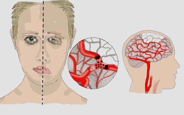 Körperlicher Verfall nach Schlaganfall: Ursachen, Verlauf und Möglichkeiten der Stabilisierung körperlicher verfall nach schlaganfall